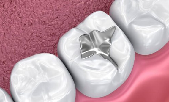 Pit and Fissure Sealants