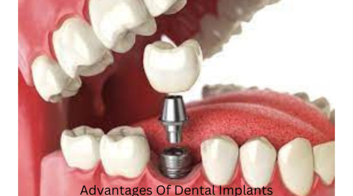 Advantages Of Dental Implants
