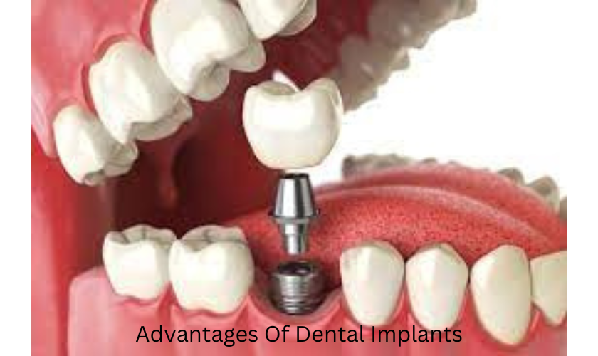 10 Advantages Of Dental Implants & Should You Get Them?