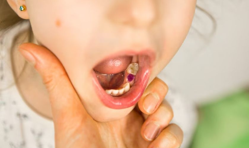 Does Silver Diamine Fluoride Stop Tooth Decay in Children?