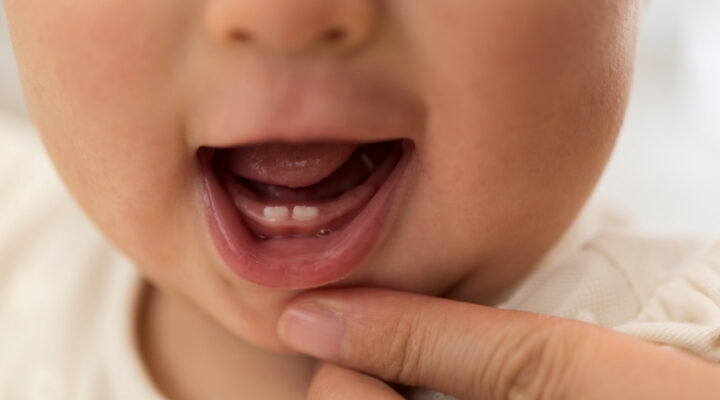 Know What You Should do If Your Veneer Falls off!