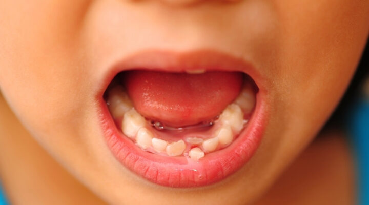 all you need to know about your childs dangling tooth