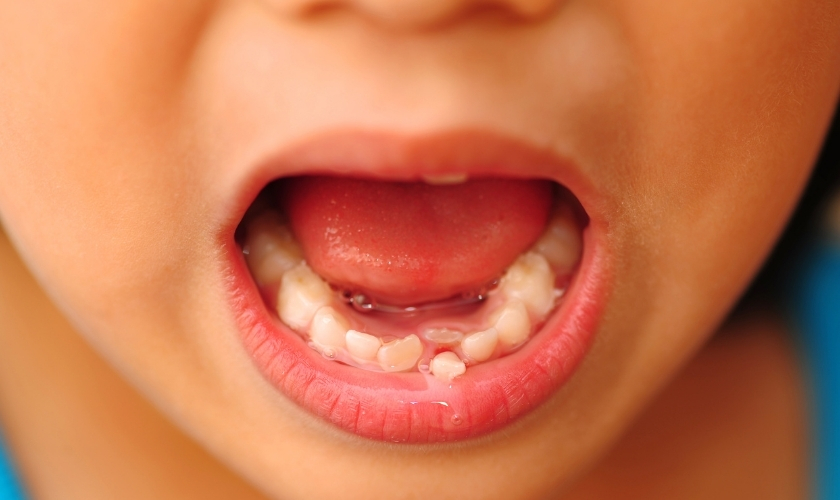 All You Need to Know About Your Child’s Dangling Tooth