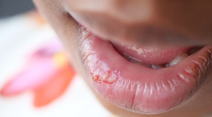 how a lip tie can affect your childs health